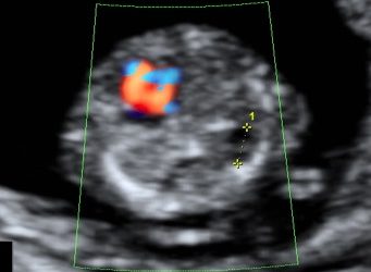 Caso del Mese di Maggio 2020