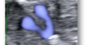 Caso del Mese di Febbraio 2021