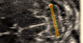 How To Do Febbraio 2021: Fossa Cranica Posteriore – Approccio Base