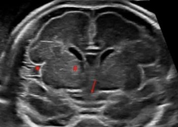How To Do Marzo 2021: La Neurosonografia