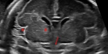How To Do Marzo 2021: La Neurosonografia