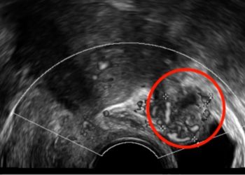 How To Do Aprile 2021: Endometriosi Anteriore e Posteriore