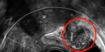 How To Do Aprile 2021: Endometriosi Anteriore e Posteriore