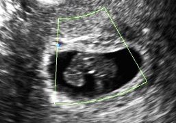 How To Do Maggio 2021: Diagnosi di Aborto Interno