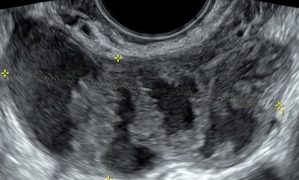 How To Do Giugno 2021: Patologia Tubarica – PID