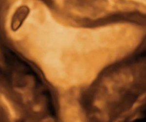 How To Do Luglio 2021: La Gravidanza Ectopica