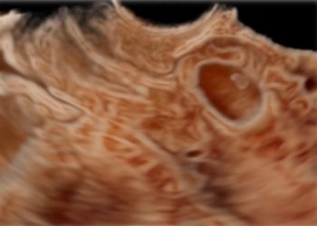 How To Do Agosto 2021: Cesarean Scar Pregnancy