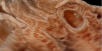 How To Do Agosto 2021: Cesarean Scar Pregnancy