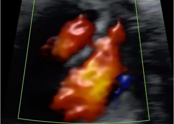 How To Do Dicembre 2021: difetti di settazione del cuore fetale