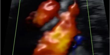 How To Do Dicembre 2021: difetti di settazione del cuore fetale