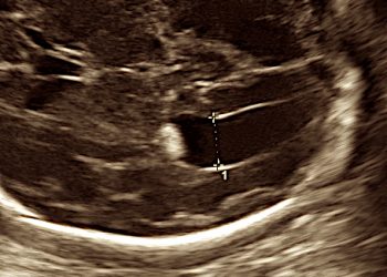 Guida al Counseling: la Ventricolomegalia