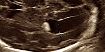 Guida al Counseling: la Ventricolomegalia