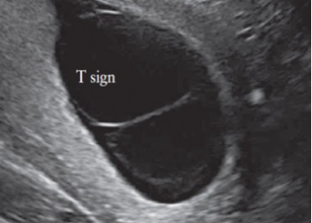How To Do Febbraio 2022: monitoraggio ecografico delle gravidanze monocoriali non complicate