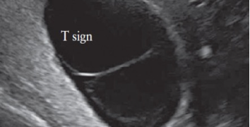 How To Do Febbraio 2022: monitoraggio ecografico delle gravidanze monocoriali non complicate