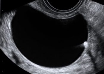 Guida al Counseling: cisti ovariche benigne