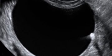 Guida al Counseling: cisti ovariche benigne