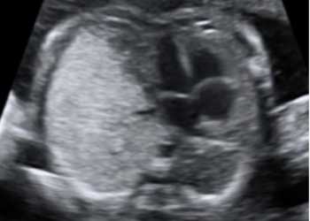 Guida al Counseling di Marzo: malattia adenomatoide cistica