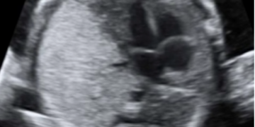 Guida al Counseling di Marzo: malattia adenomatoide cistica