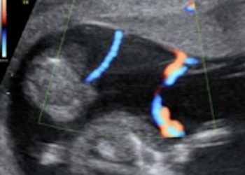 How To Do Marzo 2022: criteri diagnostici per le complicanze della gravidanza monocoriale