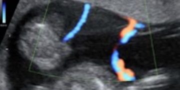 How To Do Marzo 2022: criteri diagnostici per le complicanze della gravidanza monocoriale