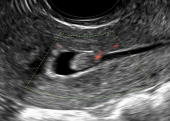 Guida al Counseling di Aprile: polipi endometriali