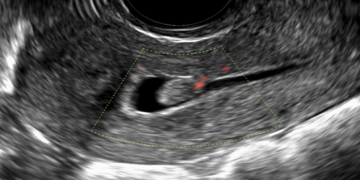 Guida al Counseling di Aprile: polipi endometriali