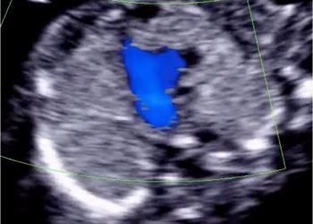 How To Do Aprile 2022: studio del cuore fetale nel primo trimestre