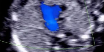 How To Do Aprile 2022: studio del cuore fetale nel primo trimestre