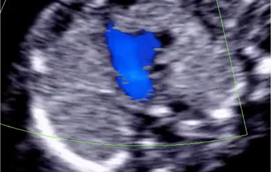 How To Do Aprile 2022: studio del cuore fetale nel primo trimestre