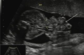 Guida al Counseling di Maggio: gastroschisi