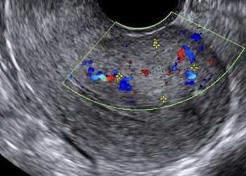 Guida al Counseling di Giugno: adenomiosi