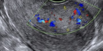 Guida al Counseling di Giugno: adenomiosi