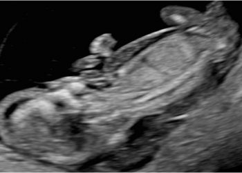 Guida al Counseling di Luglio: idrope fetale