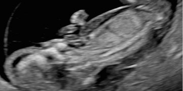 Guida al Counseling di Luglio: idrope fetale