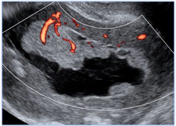 How To Do Luglio 2022: valutazione ecografica dell’endometrio e della cavità uterina secondo il consensus IETA