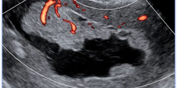 How To Do Luglio 2022: valutazione ecografica dell’endometrio e della cavità uterina secondo il consensus IETA