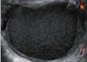 Guida al Counseling di Agosto 2022: endometriosi