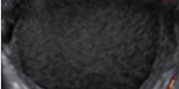 Guida al Counseling di Agosto 2022: endometriosi