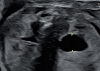 Guida al Counseling di Settembre 2022: idronefrosi