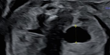 Guida al Counseling di Settembre 2022: idronefrosi