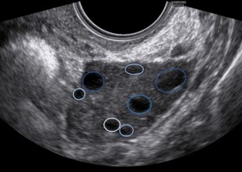 Guida al Counselling di Ottobre 2022: ridotta riserva ovarica e CFA