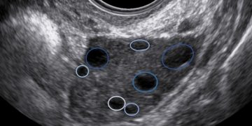 Guida al Counselling di Ottobre 2022: ridotta riserva ovarica e CFA