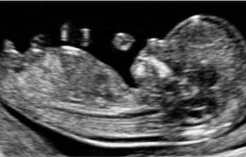 How To Do Dicembre 2022: corretta misurazione del CRL fetale