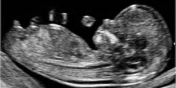 How To Do Dicembre 2022: corretta misurazione del CRL fetale