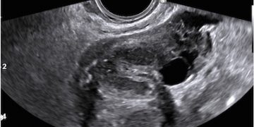 Guida al Counselling di Dicembre 2022: malattia infiammatoria pelvica