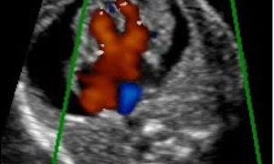 Guida al Counselling di Gennaio 2023: canale atrio-ventricolare