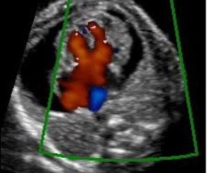 Guida al Counselling di Gennaio 2023: canale atrio-ventricolare