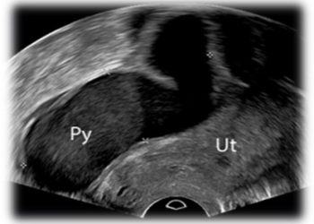 Guida al Counselling di Febbraio 2023: sactosalpinge