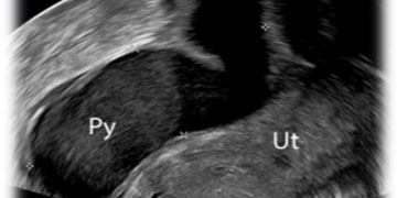 Guida al Counselling di Febbraio 2023: sactosalpinge