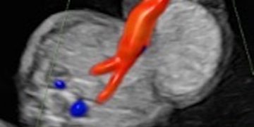 Guida al Counselling di Marzo 2023: onfalocele